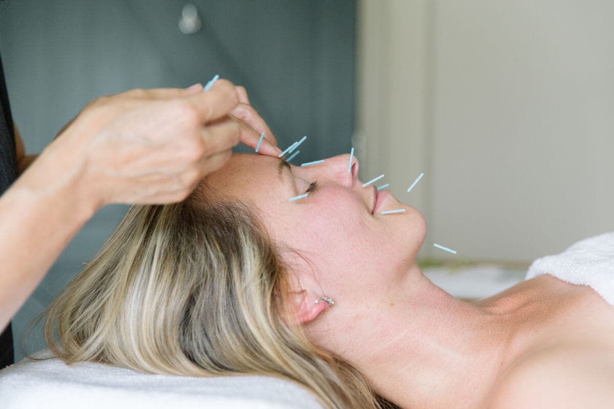Facial acupuncture treatment